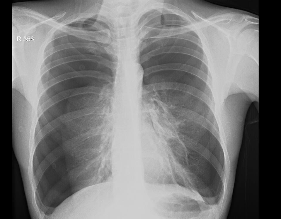 Kanabinoidų poveikis plaučiams II Gilaus įkvėpimo ir oro sulaikymo sukeltas pneumomediastinumas ar pneumotoraksas