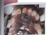 trūksta pirmojo ir antrojo prieškūminio, trečiojo krūminio bei kandinių dantų. Stambių veislių šunims (ypač dobermanų) dažniausiai hipodontija pasireiškia krūminiuose dantyse (Holmstrom, 2008).