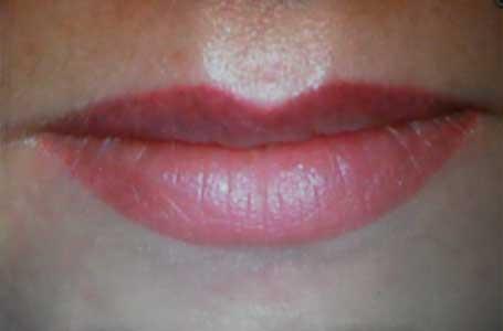 5 pav. Lūpų permanentinio makiažo pavyzdžiai MEI-CHA (R) International pigmentai išlieka odoje iki penkių metų. Laikui bėgant išsisklaido nepaliekant jokių pėdsakų.