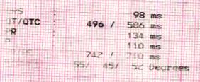 EKG stebimos pavienės monotopinės skilvelinės ekstrasistolės, širdies susitraukimų dažnis (ŠSD) 70-83 k./min., QTc 586 ms (prailgėjęs).