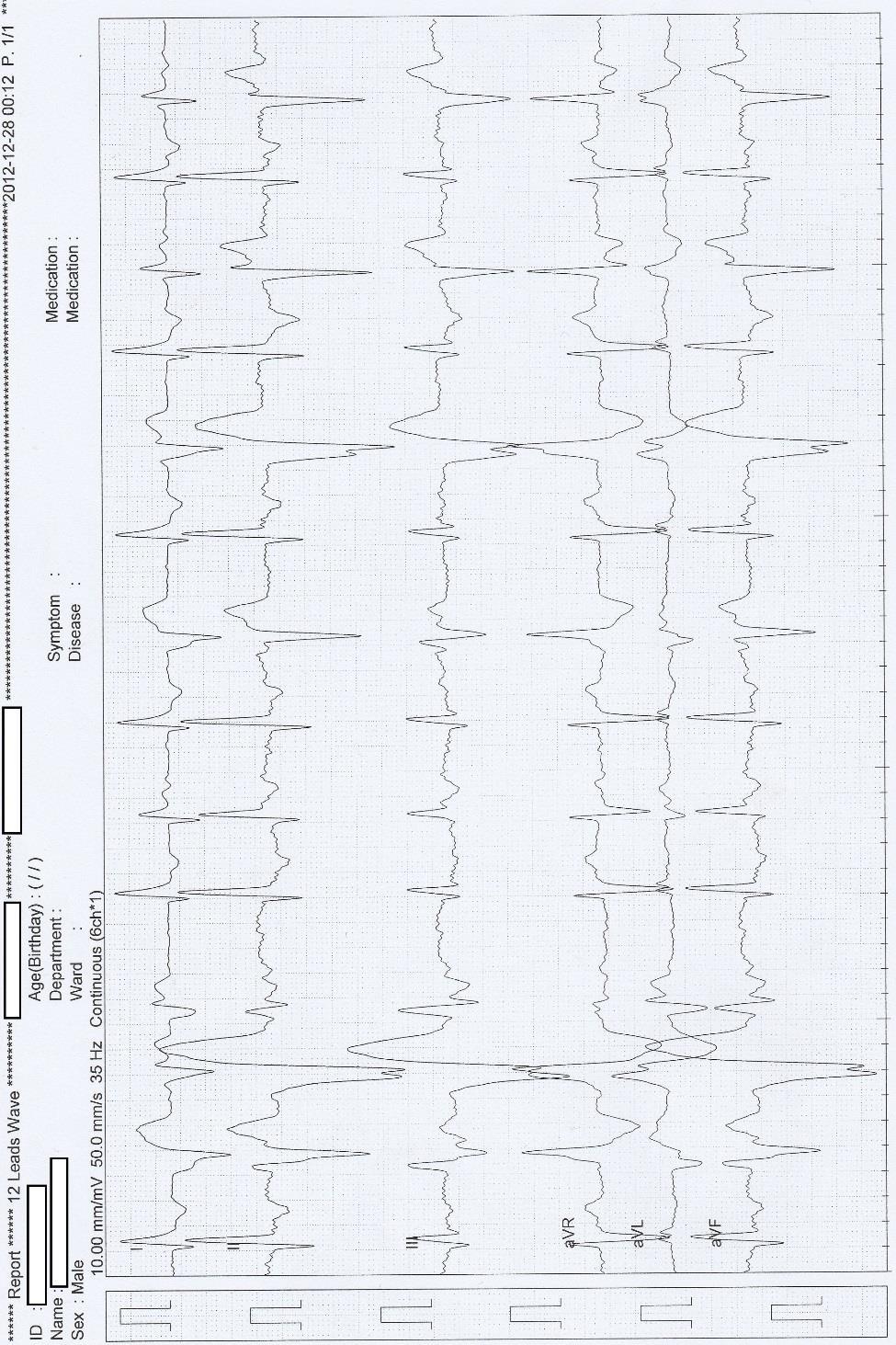 3 priedas. EKG pavyzdys Šuo, bokseris,, 7,5 m. Širdies susitraukimų dažnis 77 205 kart.