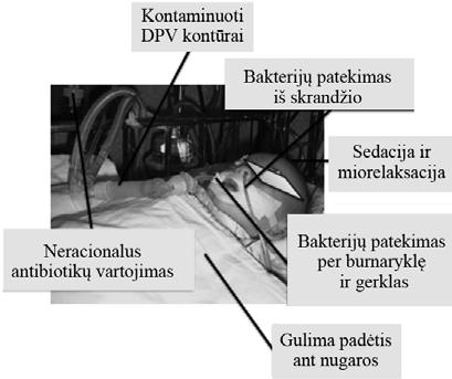 1.5.2.1 pav. Vaikų ventiliacinio tracheobronchito ir ventiliacinės pneumonijos rizikos veiksniai (pagal Palmer ir kt. 2009; Gurskį ir kt.