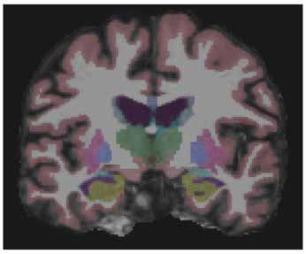 smegenis skenuojant skirtingais MRT aparatais apskaičiuojamo smegenų tūrio, žievės storio ir ploto duomenys gali skirtis [253, 254].