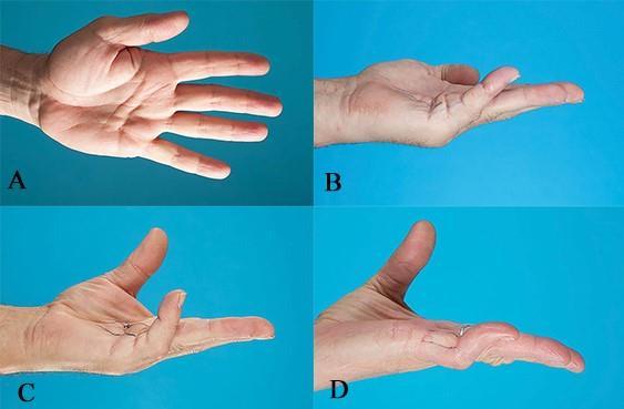 Dažniausiai pažeidžiamas yra ketvirtasis rankos pirštas, toliau seka penktasis ir trečiasis [1,20], o smilius ir nykštys į procesą yra įtraukiami rečiausiai [5].