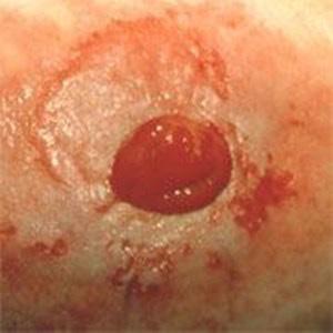 Ileostomos (plonosios žarnos stoma) turinys yra skystas ir gausus fermentų. Patekęs ant odos toks stomos turinys gali stipriai pažeisti odą dėl didelės fermentų koncentracijos.