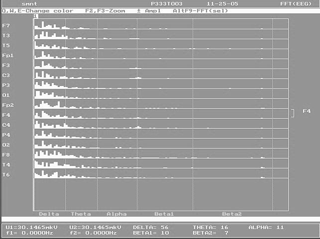 1 pav. EEG spektrinë analizë panaudojus FFT (fast Fourrier anal y sis) analizës metodà. Iðskiriamos daþnumø juostos: delta, teta, alfa, beta paþymëtos paveikslëlio apaèioje.