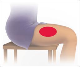 Kaip pavaizduota diagramoje, Avonex tirpalas yra švirkščiamas į raumenis, geriausia vieta injekcijai yra viršutinė išorinė šlaunies dalis. Švirkšti preparato į sėdmenis nerekomenduojama.