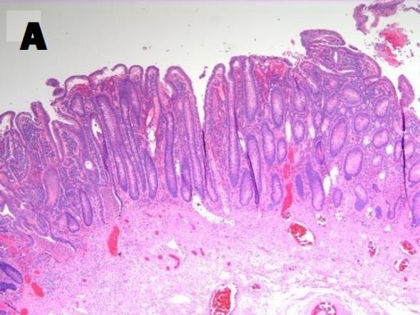 Kolonoskopijos metu sergant OK makroskopiškai randami nenutrūkstantys paviršiniai išopėjimai padengti granuliaciniu audiniu, dažnai randama hiperemiška gleivinė ir kriptų pseudoabscesai [15].