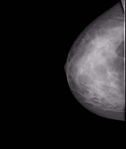 6-5-2-2 2 atvejis Ligos istorija ir mamogramos. 2 atvejis Anamnezė: kasmetinė patikra, 43 amžiaus moteris. Palpuojamų nenormalių radinių neaptikta.