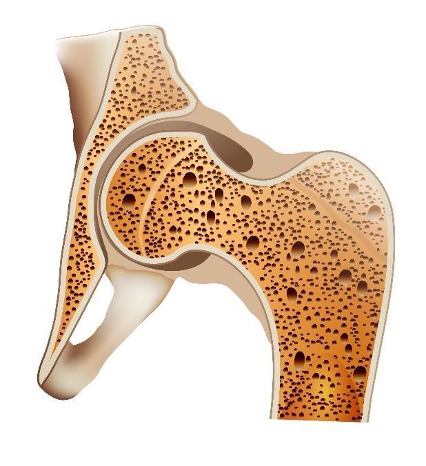 OSTEOPOROZĖ OSTEOPOROSIS. Osteoporozė atsiranda tuomet, kai organizmas netenka daug kaulų masės, gamina per mažai kaulinės medžiagos arba abiem atvejais.