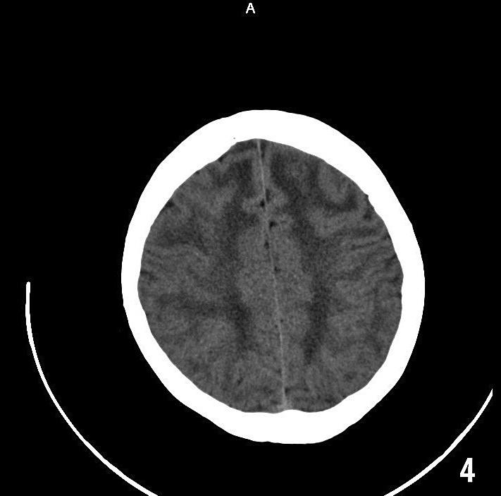 1 4 pav. Galvos smegenø KT be intraveninio kontrastavimo: abipus galvos smegenø pusrutuliuose matomos hipodensinës baltosios medþiagos zonos. var gi na 7 8 mën.
