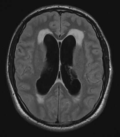 67 4 pav. Biopsijos technika naudojant Medtronic neuronavigacijos sistemą 2 pav. Paciento T. P. galvos MRT.