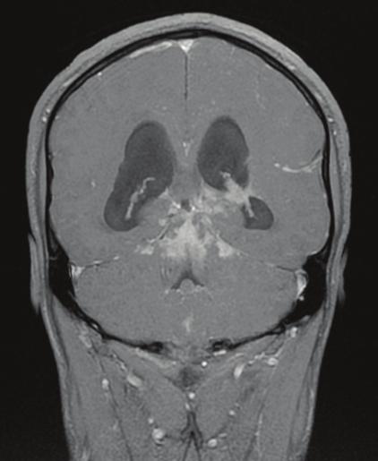 T2 FLAIR režimas, ašinis pjūvis a) b) 3 pav. Paciento T. P. Galvos MRT su kontrastu.