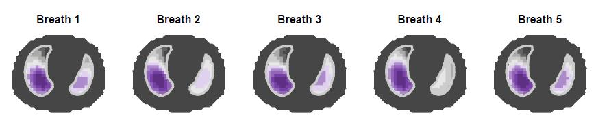 2 pav. Pirmųjų 8 minučių EIT duomenų analizės rezultatai (10 ciklų): plaučių oringumo pokyčių vizualizacija. a b 3 pav.