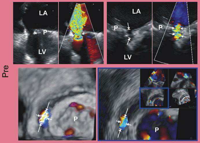 72 E.M. Onorato et al. 3. The 2D and color Doppler TEE images show the principles of the PVL measurements (arrows) in the case of flat (panel a) and tunnel (panel b) shape of the hole.
