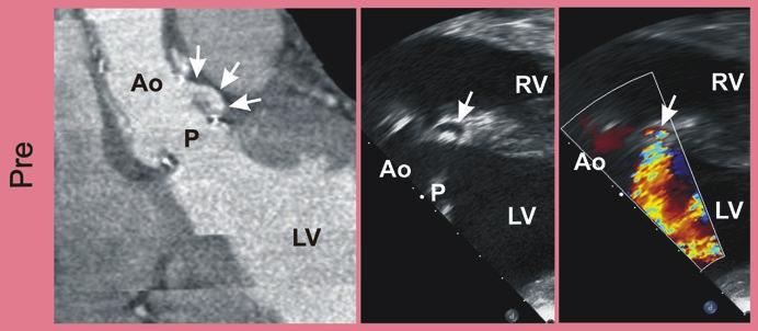 volume at the level of the hole (panel b). TEE transesophageal echocardiography, P valve prosthesis, LA left atrium, LV left ventricle a b c d 4.