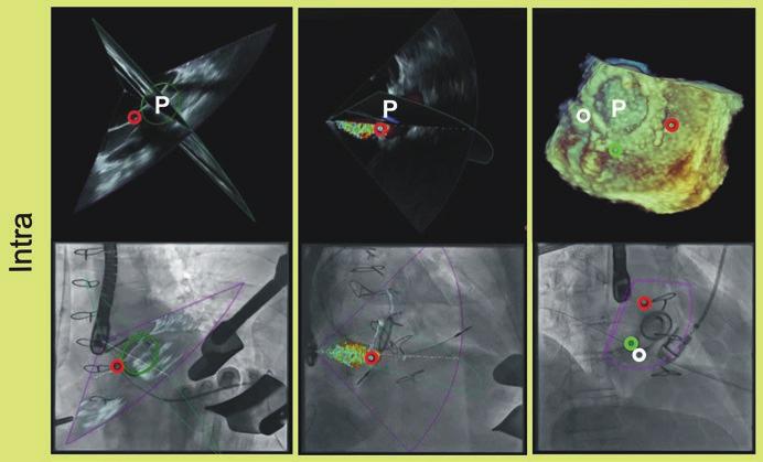 74 E.M. Onorato et al. 6. The fusion of cardiac fluoroscopy and different TEE modalities.