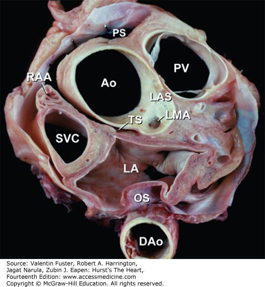 Ao, ascending aorta; DAo, descending thoracic aorta; LA, left atrium; LAS, left aortic sinus; LMA, left main