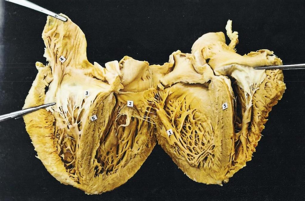 1. Mm. Papillares 2. Valva bicuspidalis (valva mitralis) 3.