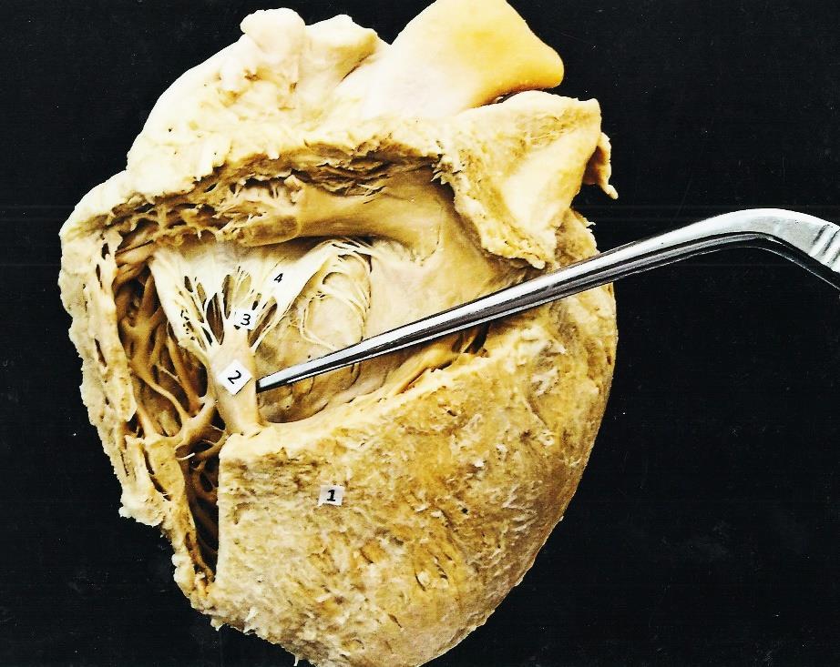 4. 1. Ventriculus dexter 2. Mm. Papillares 3. Chordae tendineae 4.