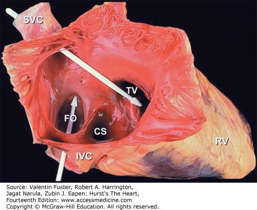 FO fossa ovalis CS, coronary