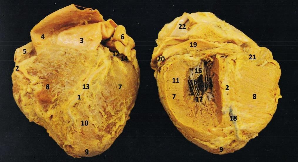 1. A. coronaria sinistra, r. interventricularis anterior 2. A. coronaria dextra 3. Truncus pulmonalis 4. Pars ascendens aortae 5. Atrium dextrum, auricula dextra 6.