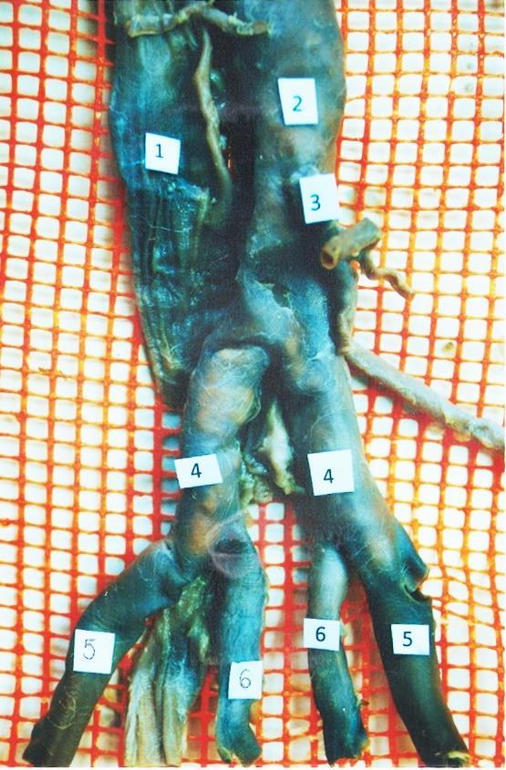 1. Vena cava inferior 2. Aorta abdominalis 3. A. mesenterica inferior 4. A. iliaca communis dextra et sinistra 5.