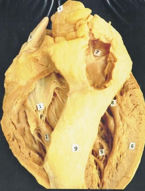 1. Valva atrioventricularis dextra, s. tricuspidalis 2. Musculi papillaris 3. Auricula dextra 4.
