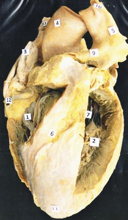 1. Valva atrioventricularis dextra, s. tricuspidalis 2. Endocardium/trabeculae carneae 3. Auricula dextra 4. Aorta 5. Truncus pulmonalis 6.