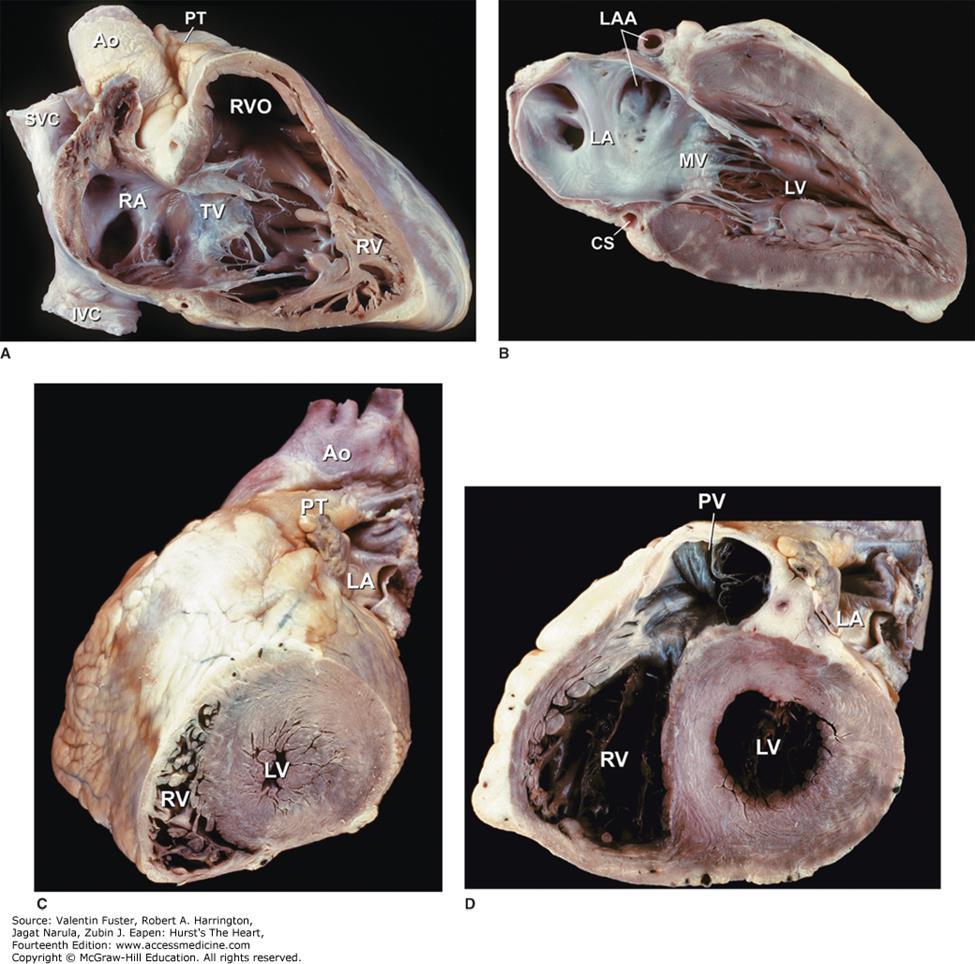 Ao, ascending aorta; CS, coronary sinus; IVC, inferior vena cava; LA, left atrium; LAA, left atrial appendage; LV, left ventricle; MV, mitral valve; PT,