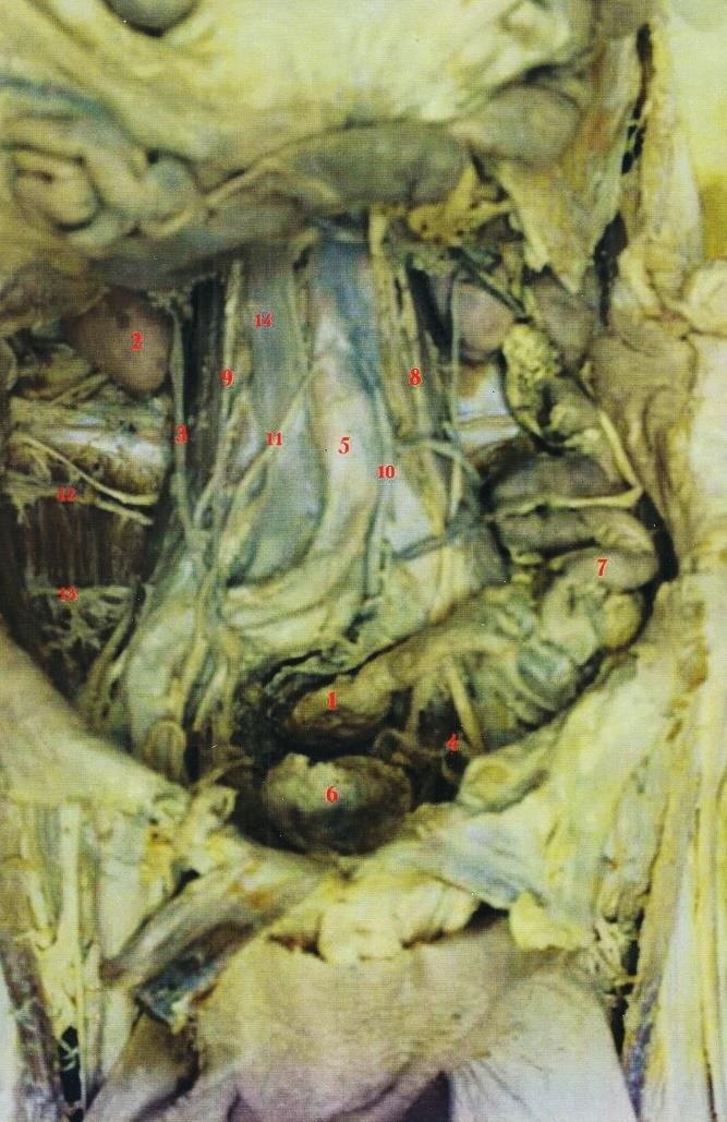 1. Rectus 2. Ren 3. Ureter 4. Ductus deferens 5. Aorta 6. Vesicae 7. Colon sigmoideum 8. V. testicularis dexter 9. V. testicularis sinister 10.