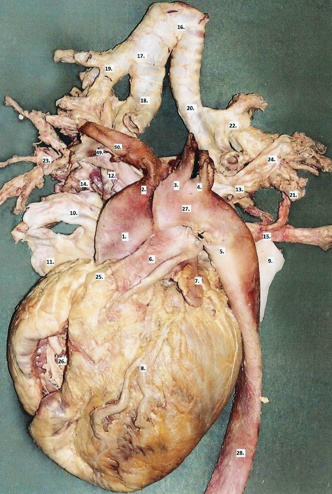 1. Pars ascendens aortae 2. Truncus brachiocephalicus 3. A. carotis communis sinistra 4. A. subclavia sinistra 5. Lig. arteriosum 6. Truncus pulmonalis 7. Auricula sinistra 8. A. coronaria sinistra, ramus interventricularis anterior 9.