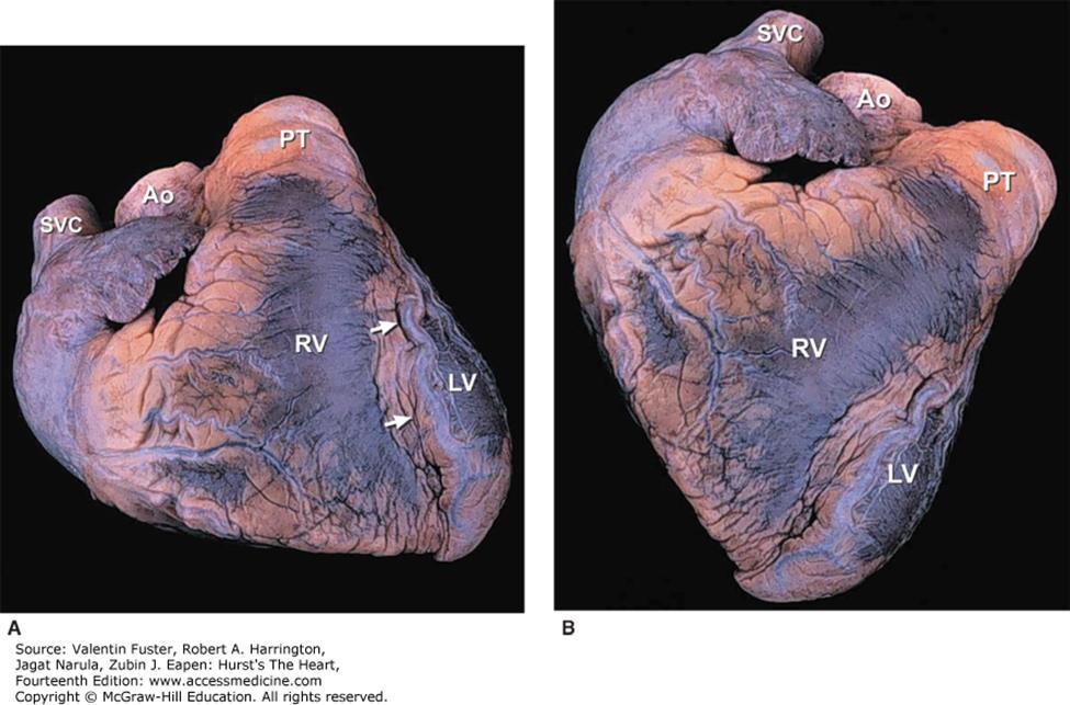 Ao, ascending aorta; LV, left ventricle; PT,