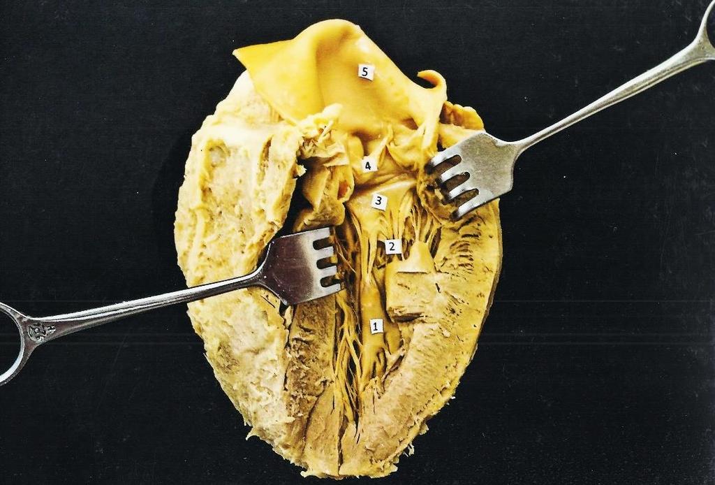 1. Mm. Papillares anterior 2. Chordae tendineae 3.