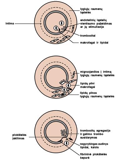 Lipoproteinai, jų sudėtis, apykaita... a) pradinis pažeidimas b) plokštelės formavimasis c) antrinio trombo susidarymas ir organizuota plokštelė 26 pav.