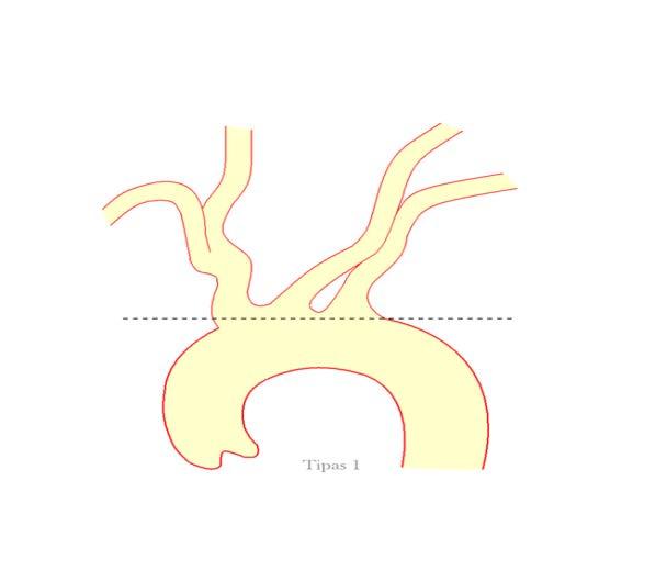 2 pav. Pirmo tipo aortos lankas Antrojo tipo aortos lanke tr.