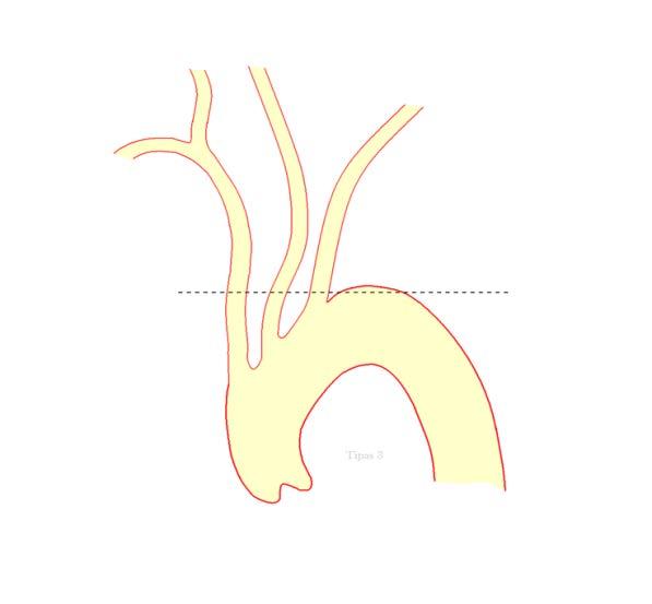 4 pav. Trečio tipo aortos lankas Kuo žemesnės arterijos žiotys, tuo sunkiau pasiekiama miego arterija. Be to, aortos lanko tipas yra svarbus didžiųjų kraujagyslių formai ir eigai.