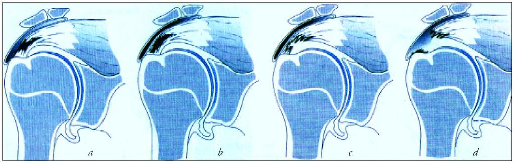 14 nusilpsta mažųjų sukamųjų raumenų funkcija ir žastikaulio galva, susitraukus deltiniam raumeniui, pradeda kilti į viršų, pasireiškia ankštumo sindromas po petine atauga.