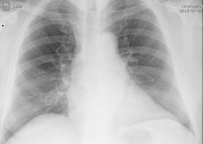 Fibroziniai plaučių audinio pokyčiai priešakninėse zonose.