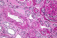 Piktybinė hipertenzija ir MAHA Patogenezė: endotelio pažeidimas-arteriolių