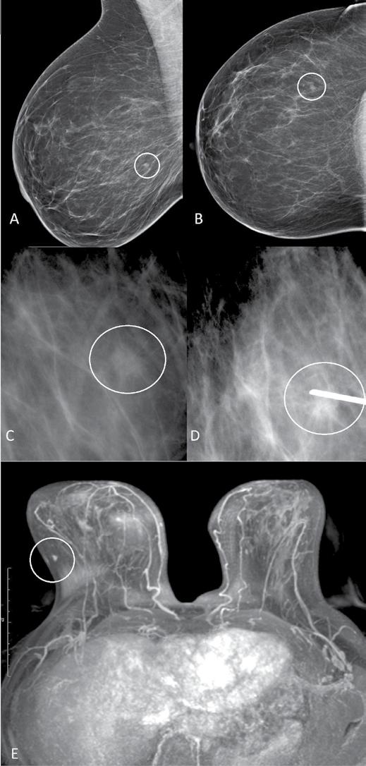 1 pav. A ir B pacientės dešinės krūties mamogramos: apatiniame išoriniame kvadrante 6 mm apvalus darinys (apvestas baltu apskritimu) BIRADS 4.