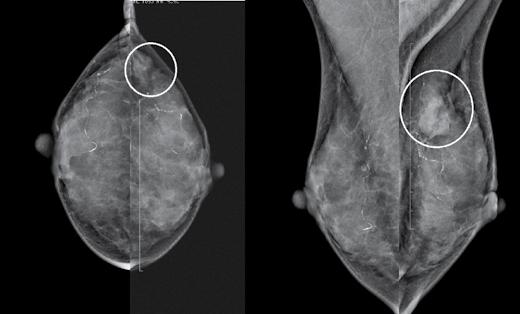 tojų ir sporadinio krūties vėžio požymius. Mutacijų nešiotojoms nepasitaikė klasikinių navikų su spikulėmis mamogramose, daugiausia nurodoma riboti dariniai, bei vos keli dariniai su mikrokalcinatais.