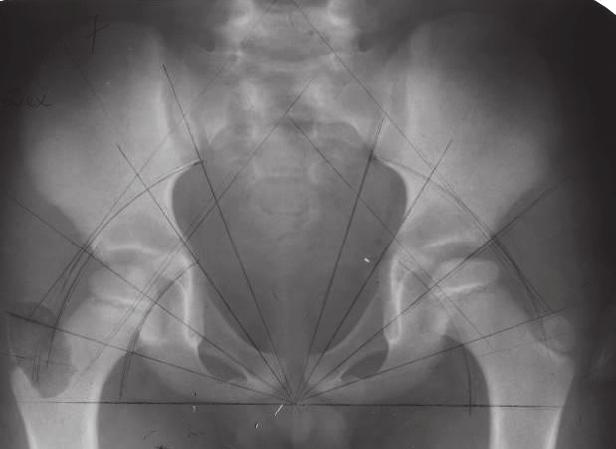 13 pav. Rentgenogramoje iš kairės pusės vidinė lateropozicija 10 mm, išorinė 10 mm, ryški kaulėjimo branduolio lateropozicija, kuri turėtų būti vidinės arkos vidinėje pusėje.