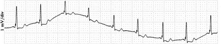 1.3 Triukšmų tipai elektrokardiogramoje Svarbu yra susipažinti su dažniausiai pasitaikančiais triukšmų tipais, bei artefaktais prieš taikant įvairius EKG signalų apdorojimo metodus.