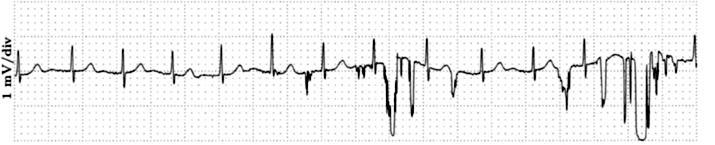 vibracijai. Toks kontakto praradimas ir atsiradimas matavimo sistemoje gali sukelti didelius artefaktus EKG signale [23] (žr. 8 pav.). 8 pav. Elektrodų judėjimo artefaktai EKG signale.