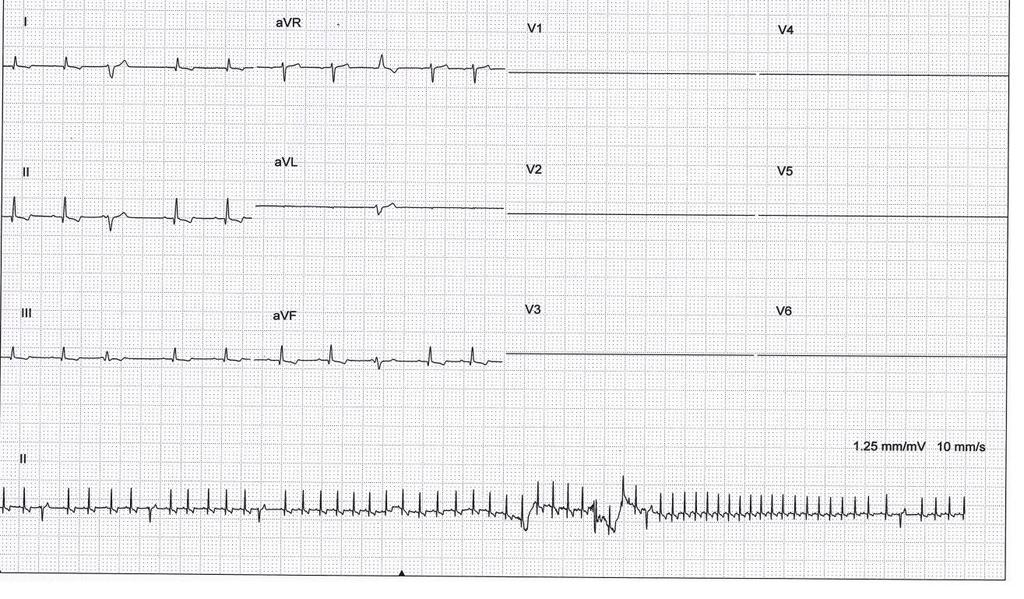 4 priedas. EKG pavyzdys Vipetas, patinas, 3 m.
