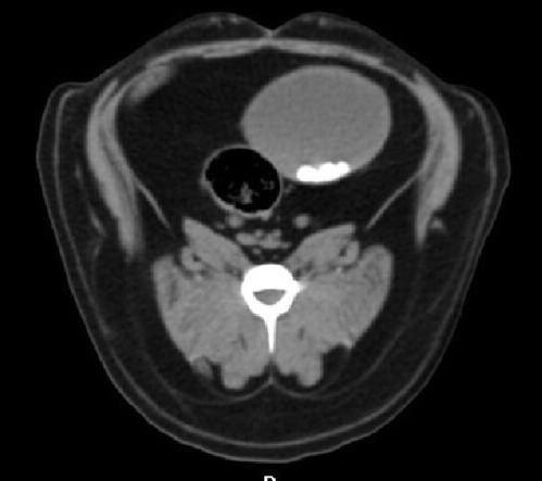 6 pav. Pilvo srities kompiuterinės tomografijos metu matomi kalcio oksalatai šlapimo pūslėjė (5)
