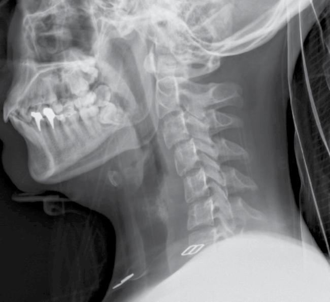 Kaip matyti iš pavyzdžio, tokius panirimus gali sukelti ir netipinė vaiko galvos padėtis atliekant rentgeno tyrimą (3 pav.) ar kitoks priverstinis laikymas (1 pav.). Santykinai didesnė galva ir silpni kaklo raumenys.