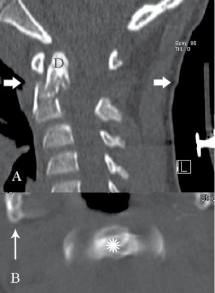 4 pav. Į vandenį nėrusio 9 m. berniuko kaklo kompiuterinės tomografijos (KT) vaizdai (A ir B). Pacientas skundėsi kaklo skausmu, neurologinės simptomatikos neturėjo.