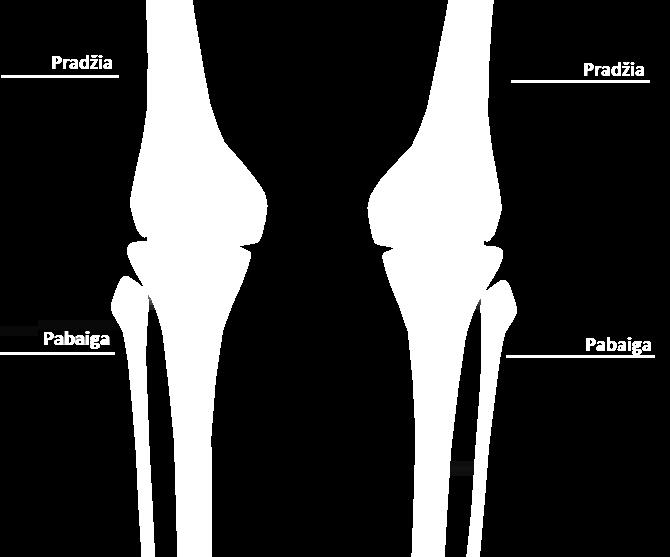 KELIO SĄNARIO 3D REKONSTRUKCIJA Paciento kojos ištiestos lygiagrečiai tomografo stalui Girnelių priekiniai paviršiai lygiagretūs su tomografo stalo paviršiumi Pėdos statmenos tomografo stalo